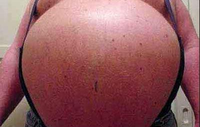 Obesità, le nuove generazioni vivranno meno